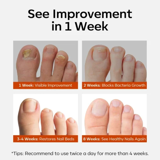Nail Antifungal Treatment - Image 5