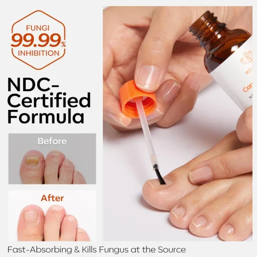 Nail Antifungal Treatment - Image 6